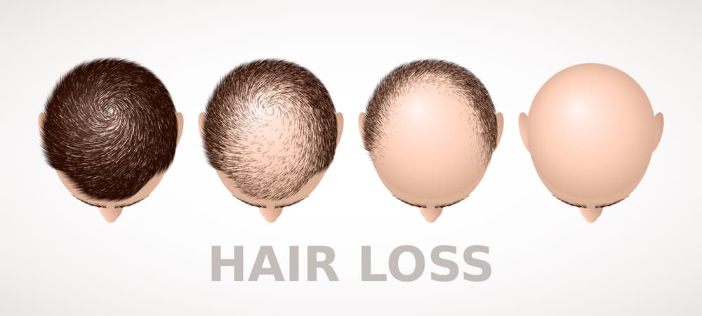 hair loss stages
